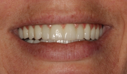 Close up of complete smile after getting implant dentures